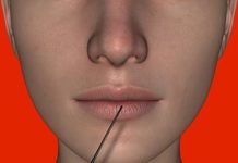 Botoks – ile kosztuje i jak odbywa się zabieg wstrzykiwania botoksu Botoks