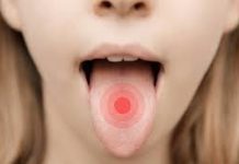 Plamy i krosty na języku