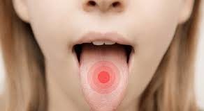 Plamy i krosty na języku